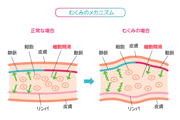 むくみのメカニズム